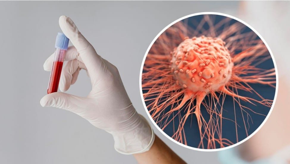 рецидив раку молочної залози